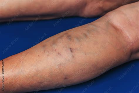 Foto De Varicose Veins In An Elderly Woman Inflamed Dilated Veins In