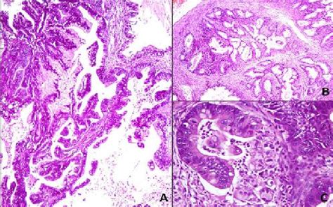 A Ovarian Mucinous Adenocarcinoma With Architecturally Complex