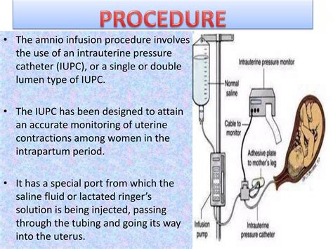 Amnioinfusion Ppt