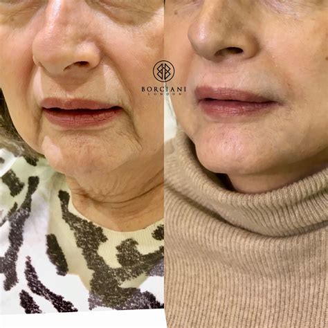 What A Transformation We Used Dermal Fillers Directly In The