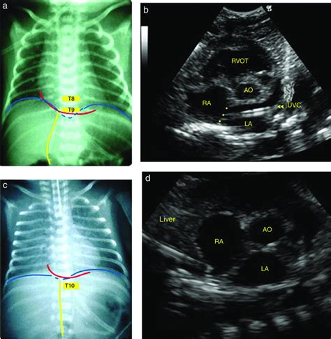 Umbilical Venous Catheter X Ray Images And Photos Finder