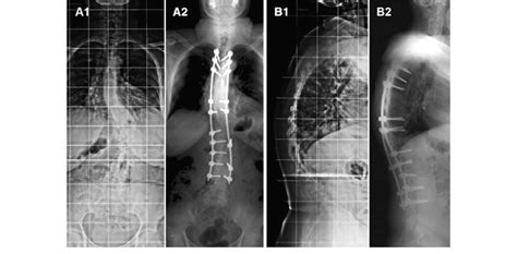 Pre Operative And Post Operative Full Spine Radiographs Of A Patient Download Scientific