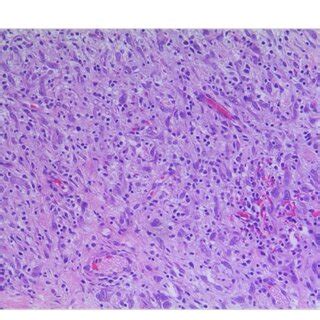 FIGURE E Pathological Section Of Tumor With Myxoid Background Round