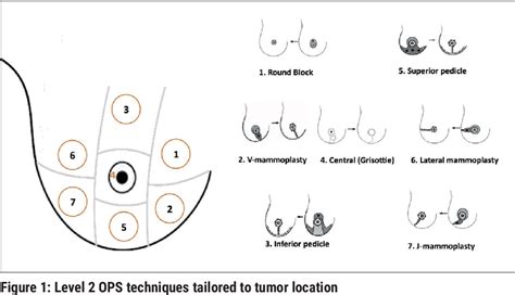 Figure From Level Oncoplastic Surgical Techniques For Breast Cancer