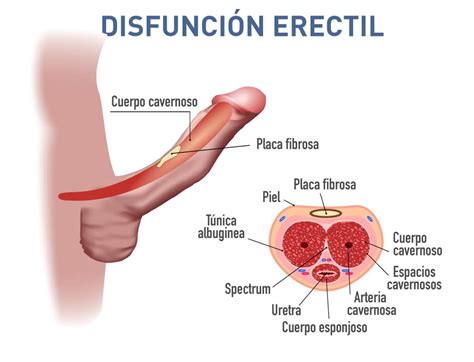 Disfunción Eréctil Síntomas Causas Y Tratamientos Efectivos