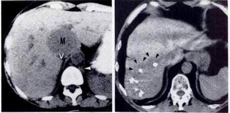 -Calcified liver metastases. Multiple coarse calcifications in ...