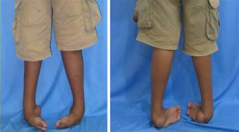 Correcting Recurrent Rigid Clubfoot Deformity with Surgical Expertise ...