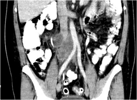 Technique And Outcomes Of Concomitant Aortic And Caval Resection And