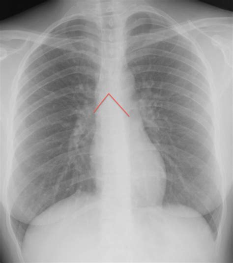 Carina Chest X Ray