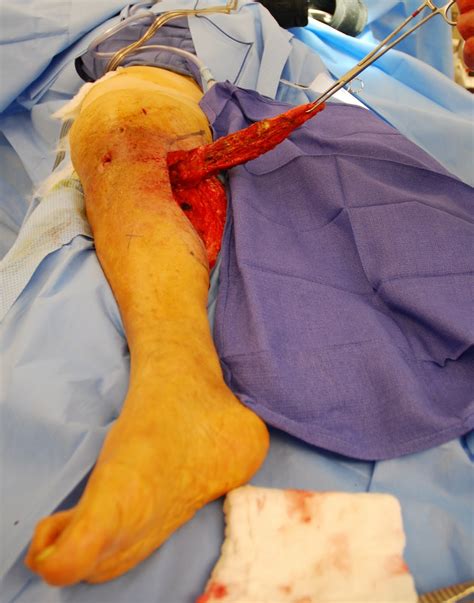 Flap Surgery: Autologous Tissue, Wounds, Microvascular Free Flaps