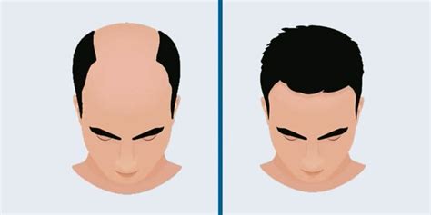 How successful are various hair transplant techniques? | Bright Eyes News