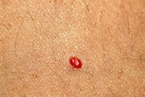 Red Moles Or Freckles What Are They Should You Worry