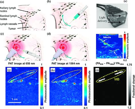 Photoacoustic US Imaging Approach For Minimally Invasive SLN Staging