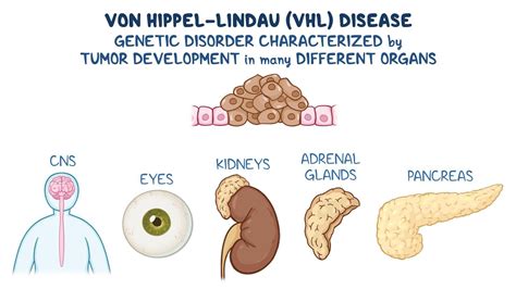 von hippel lindau disease year   zebra  video