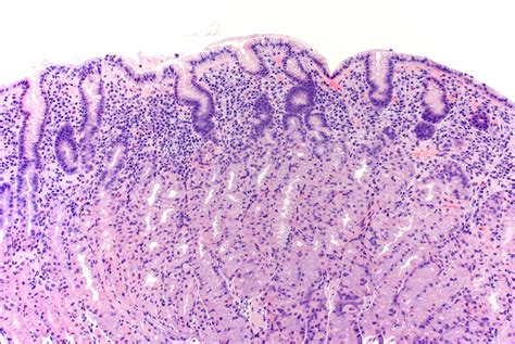 Helicobacter Pylori Gram Stain