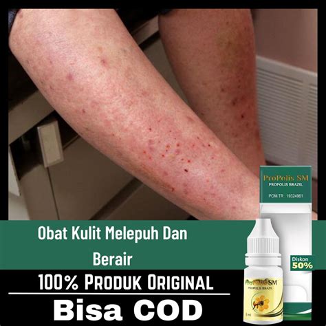 Jual Obat Kulit Melepuh Dan Berair Obat Luka Bakar Pada Kulit Kulit