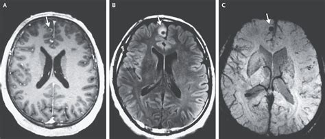 Brain Tapeworm