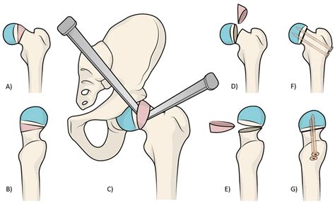 Jcm Free Full Text The Medium To Long Term Results Of Vascular