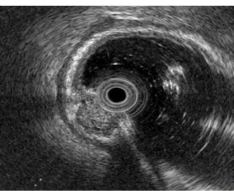 Endoscopic Ultrasonography Demonstrating A Hypoechoic Tumor And