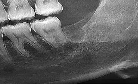 Glandular Odontogenic Cysta Case Series Journal Of Oral And