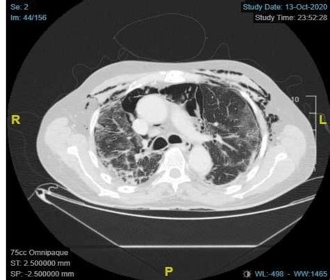 Extensive Pneumomediastinum With Subcutaneous Emphysema And Signs Of