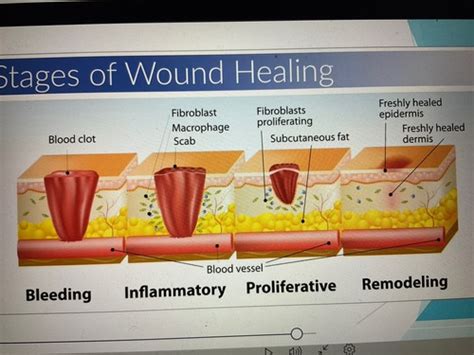 Wound Healing Flashcards Quizlet