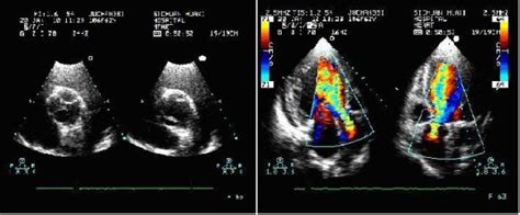 The Preoperative Transthoracic Echocardiogram Tte Disclosed A