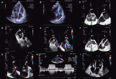 Severe Postransplant Tricuspid Regurgitation Treatment With The Pascal