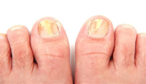 how to fix damaged toenails