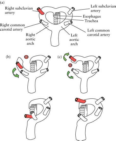 Right Aortic Arch With Aberrant Left Subclavian