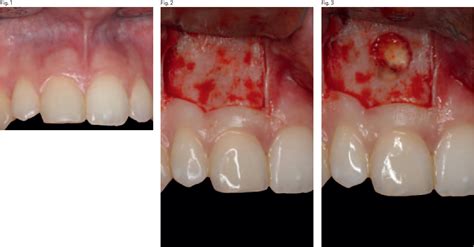 Figure 3 From Flap Design New Perspectives In Periapical Surgery