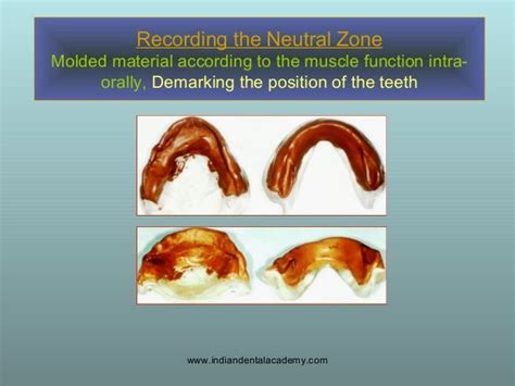 Concept Of Neutral Zone Dental Seminars