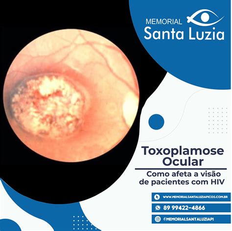 Toxoplasmose ocular Como afeta a visão de paciente HIV