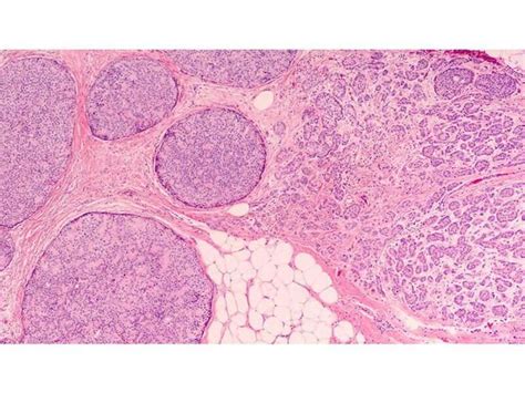 Ai Model Enhances Histologic Grading Of Breast Cancer