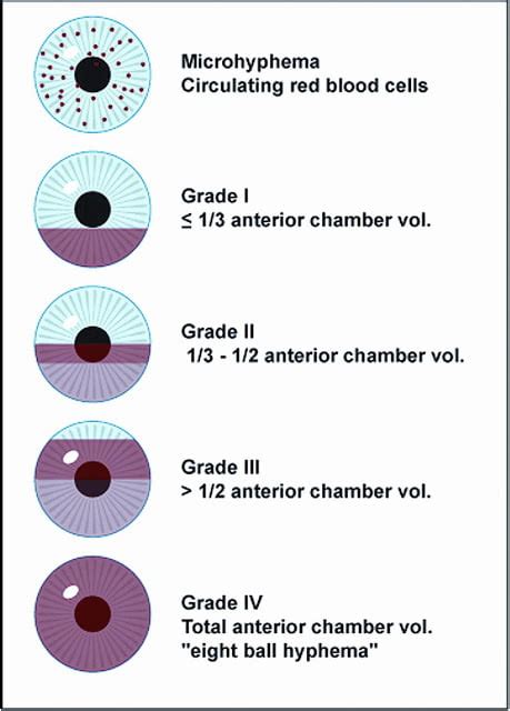 Grading In Ophthalmology Eye Health Nepal