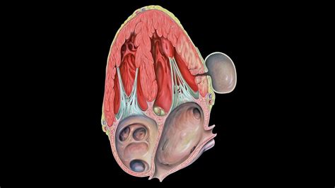 Left ventricular pseudoaneurysm - YouTube