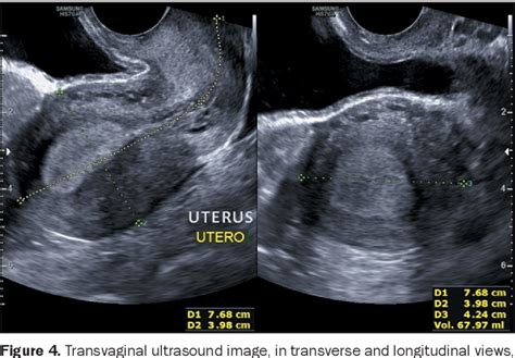 [PDF] Reporting of uterine fibroids on ultrasound examinations: an ...