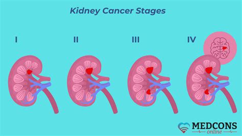 Kidney Cancer Causes And Manifestations Diagnosis And Treatment Methods