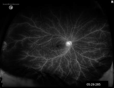 Ocular Ischemic Syndrome (OIS) – June, 2023 | Illinois Retina ...