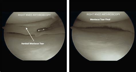 Meniscus Tear Treatment - Century City Los Angeles, CA: Commons Clinic