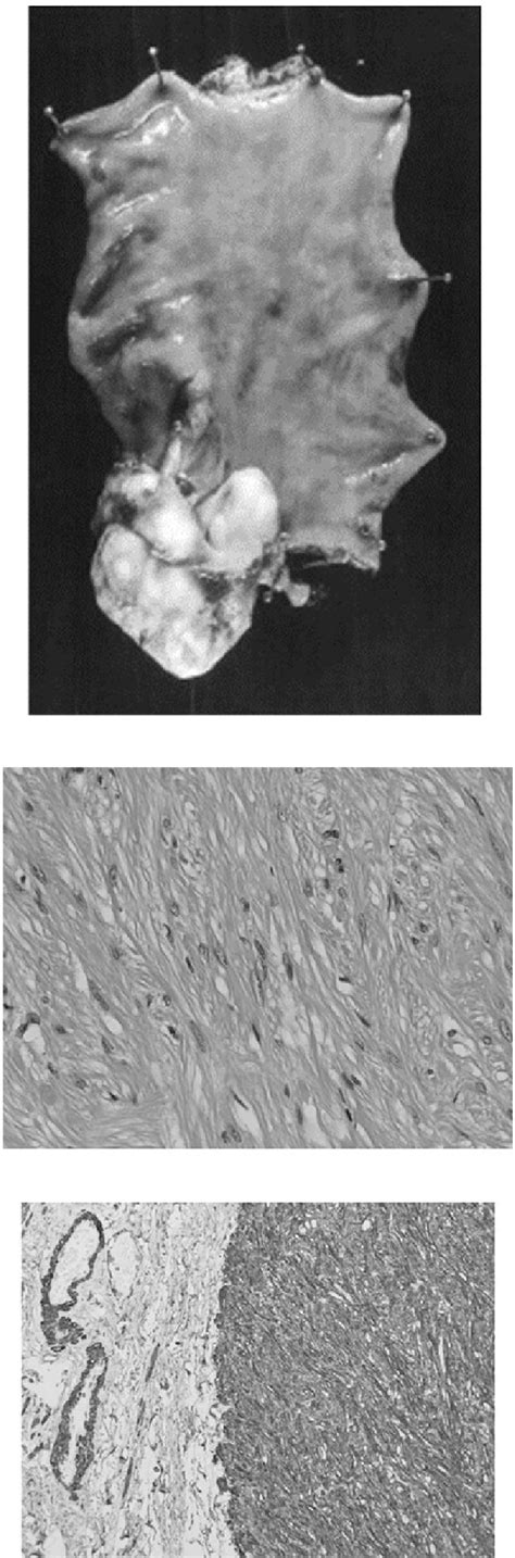 Images Of The Resected Esophageal Submucosal Tumor Smt A Gross