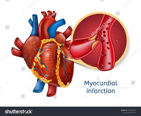 Myocardial Infarction Images Stock Photos Vectors Shutterstock