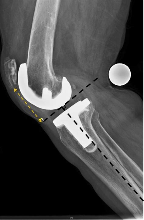 Reconstruction Of Disrupted Extensor Mechanism After Total Knee