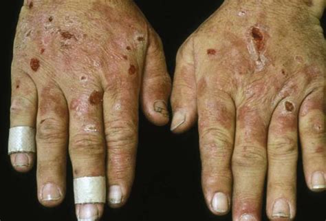 Cleveland Clinic Dermatologic Signs Of Systemic Disease Virtual