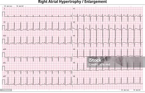 Ecg Right Atrial Enlargement 12 Lead Ecg Common Case 6 Sec Lead