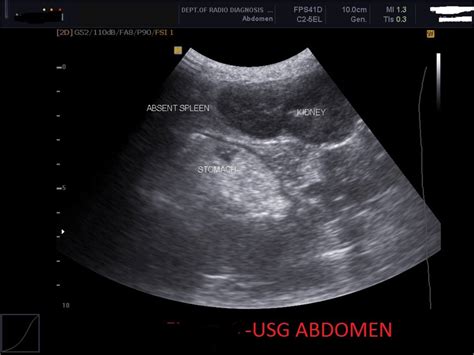 Abdominal Ultrasound Made Easy Step By Step Guide Pocus Off