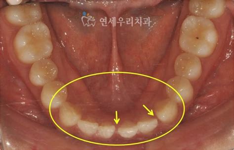 교정전문의 진료일지 벌어진 앞니 치아 부분교정으로 개선했어요 송파교정치과 연세우리