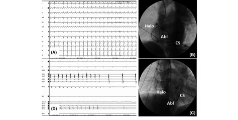 Panel A Twelve Lead Preprocedural Ecg Demonstrating Typical