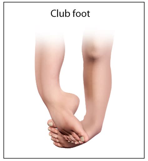 Club Foot And Congenital Deformity Memphis Foot Deformity Memphis