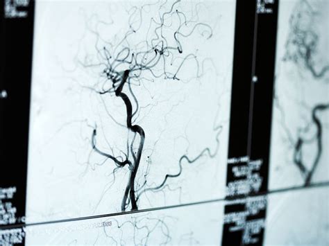 Arteriogram Types Procedure And Results